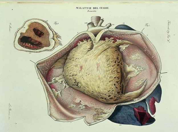 Diseases of the heart (Source: Public Domain)