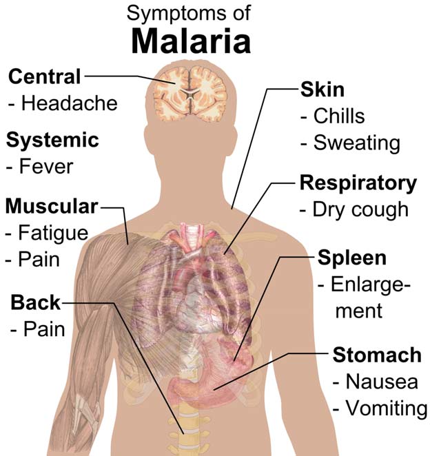 Main symptoms of malaria (Public Domain)