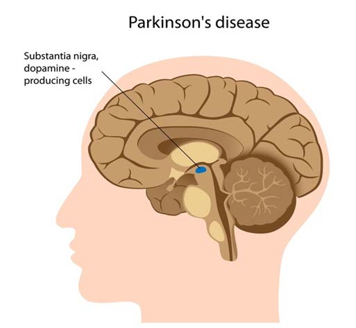 PD affects the substantia nigra in the brain, a region that controls balance and movement. (Source: NIH, Genetics Home Reference)