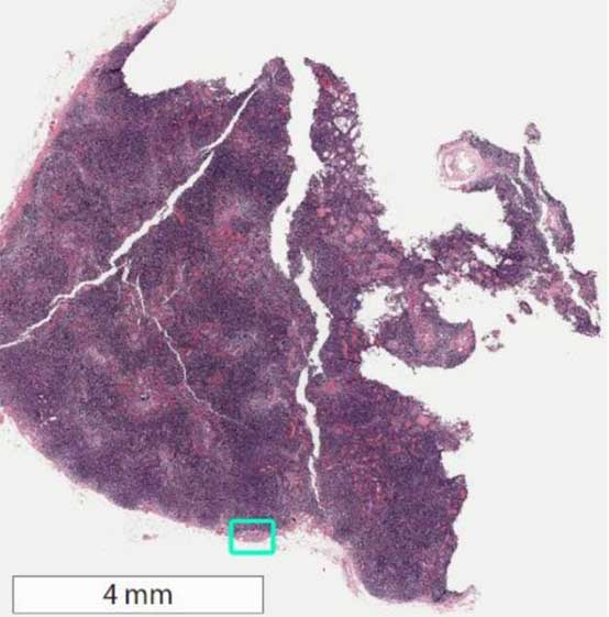 Whole-slide image of sentinel lymph node biopsy with area of metastatic breast cancer highlighted in green square
