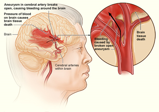 This diagram highlights cerebral artery aneurysms and what happens when one of them bursts. (Source: National Heart Lung and Blood Institute (NIH))