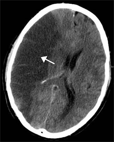 Brain with ischemic stroke, as seen in a CT scan. (Source: Wikipedia)