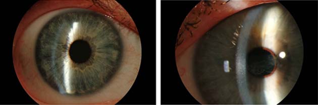 Eye of a person with a healthy cornea (left) vs. eye of person with corneal disease. (Source: Carolina Eye Associates)