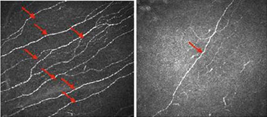 Left pane shows corneal image of diabetic (neuropathy) patient with loss of corneal nerve fibers, while the right pane shows a normal corneal nerve. (Source: Tavakoli, M. et al., 2014)