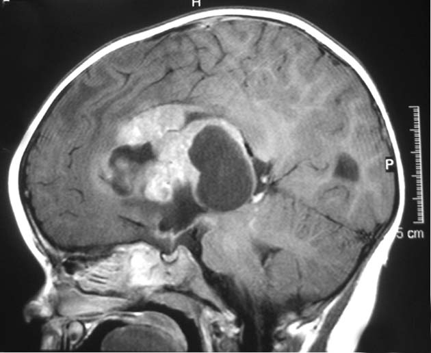 Magnetic Resonance Image of a supratentorial atypical teratoid/rhabdoid tumor (ATRT) in a young child 