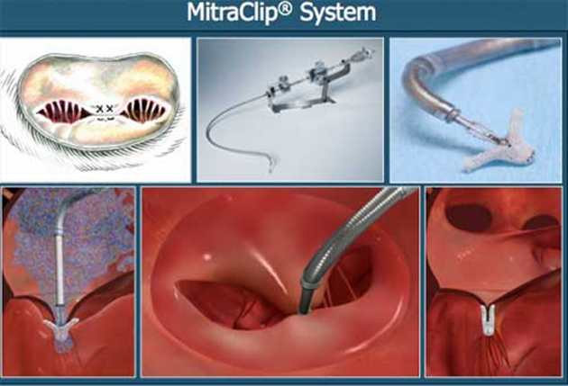Minimally-invasive therapy that implants the ‘MitraClip’ that can treat mitral valve failure. (Source: MitraClipÒ/Hive Health Media)