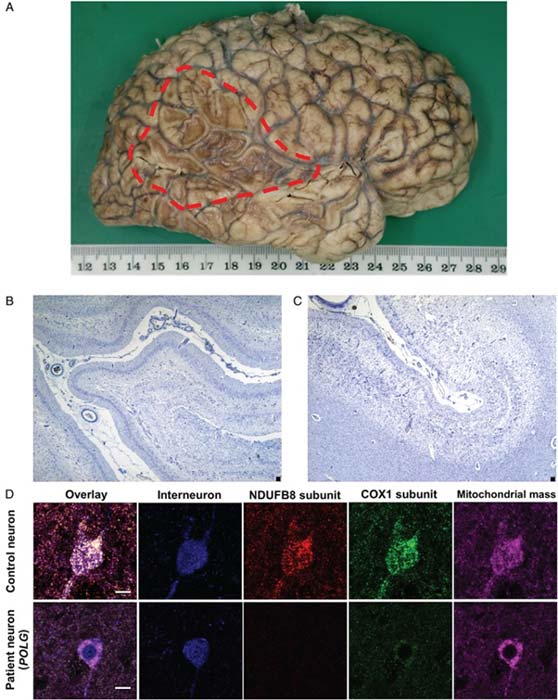 The brain tissue of a patient with a mitochondrial disorder (A), a cortical sample showing atrophy (the paler spaces; B % C) and cell-staining imaging studies with a normal control. (Source: C. L. Alston et al, 2017)