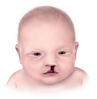 Illustrated baby with a cleft lip. Researchers at Yale University and UConn conducted a detailed genomic study that proved that epigenetic enhancers had a role to play in the development of cleft lips and/or cleft palates. (Source: Wikimedia Commons)