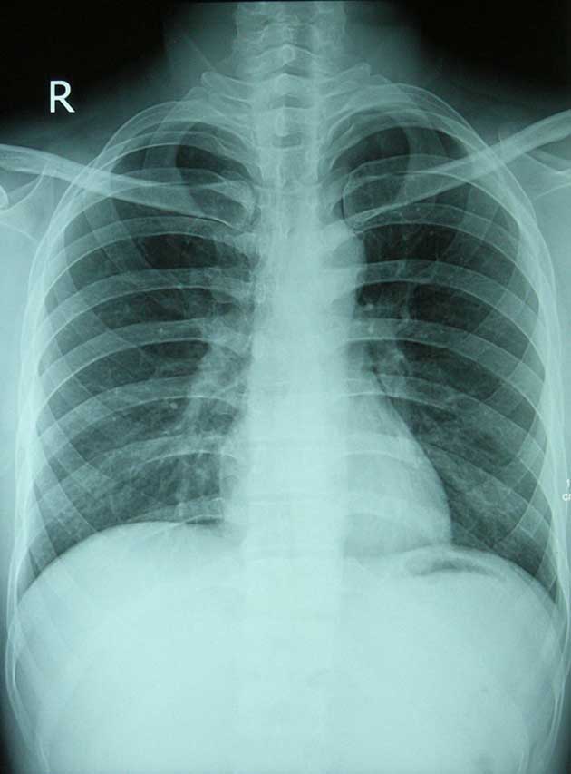 Some of the patients in the pilot study were also assessed with additional procedures such as chest X-rays, as deemed appropriate. (Source: Wikimedia Commons)