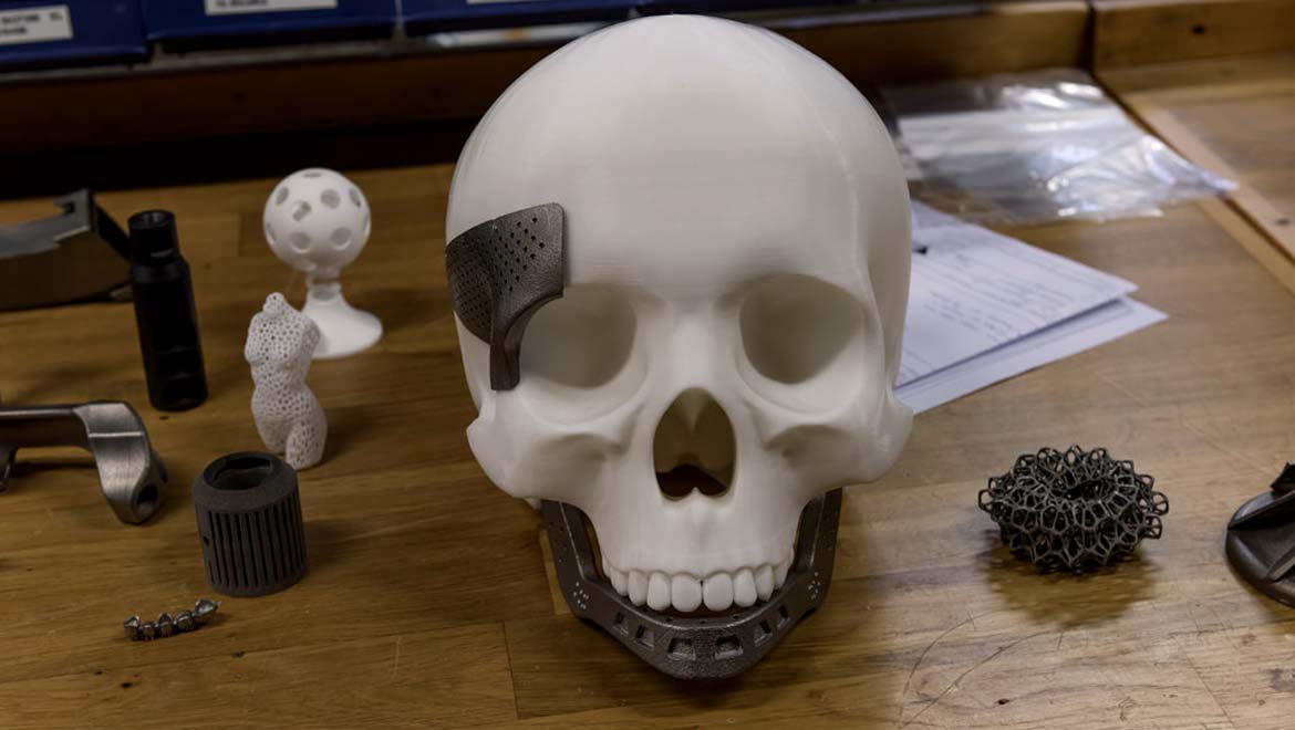 3D Printing to Heal Skull Fractures