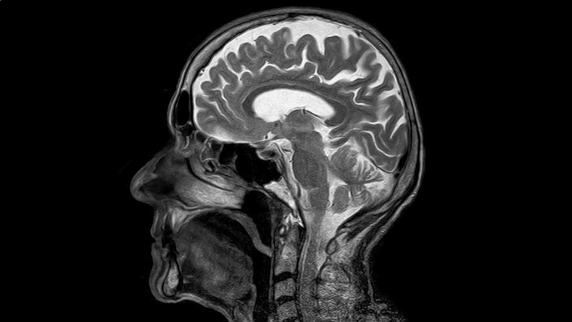 MRI scans of brain