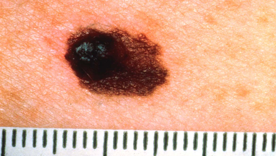 New Hope for Old Melanoma Treatment: Study Indicates Potential for Anti-PD-1 in Novel Combination