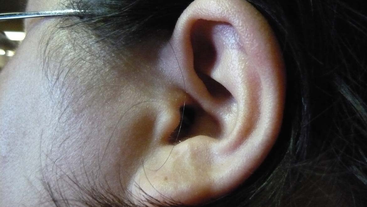 Tuning Out Tinnitus: New Study Indicates Possible New Therapy for This Condition