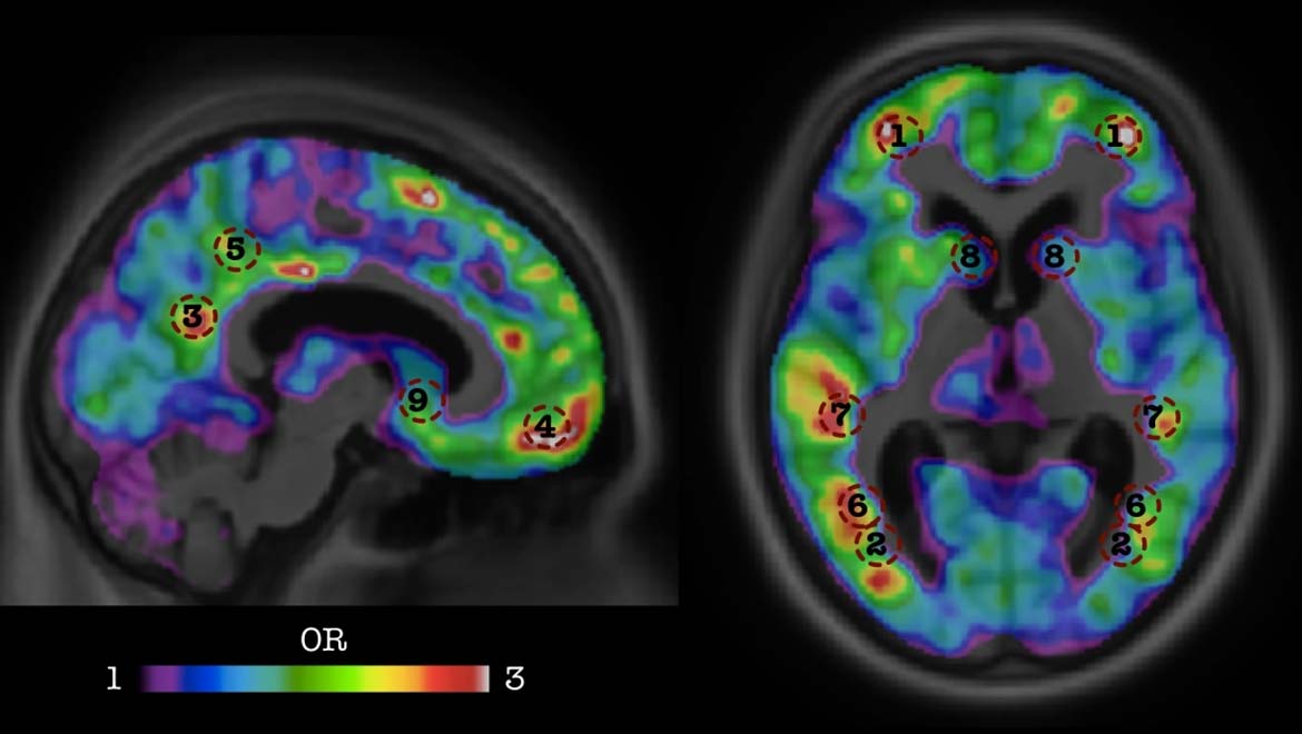 Novel AI Enhances Detection of Alzheimer’s Disease Risk