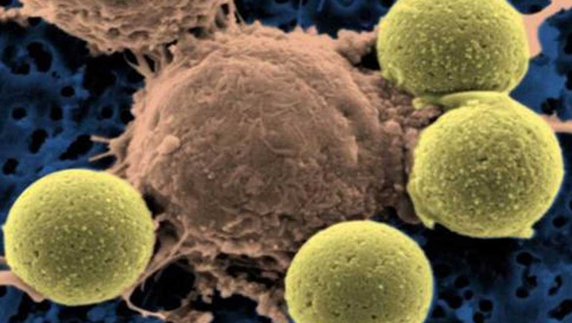 First Gene-Altering ‘Living Drug’ for Cancer Developed
