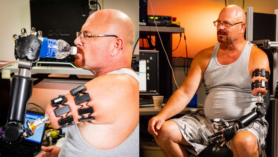 A pioneering surgical technique has allowed an amputee to attach APL’s Modular Prosthetic Limb directly to his residual limb, enabling a greater range of motion and comfort than previously possible. Credit: JHUAPL