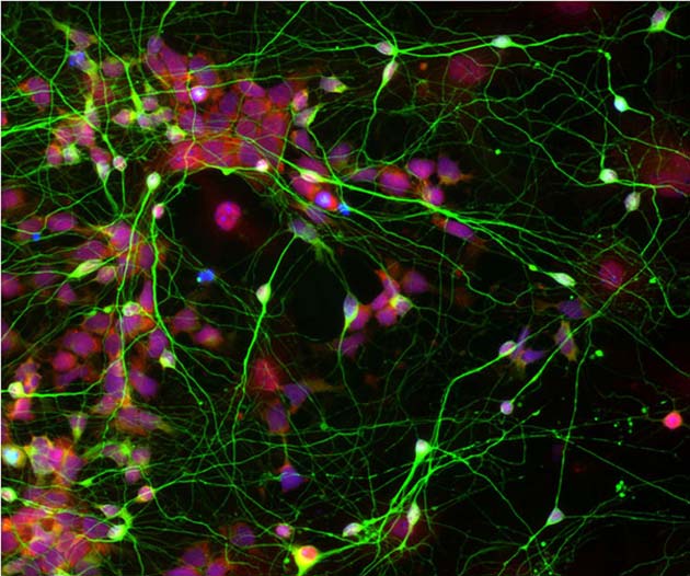 Microscope view: stem cells reprogrammed from adult skin cells (red blobs), morphing into human brain cells (green blobs) 