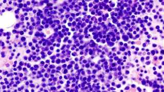Latest Technology Can Identify Multiple Myeloma Cells Faster Than Ever