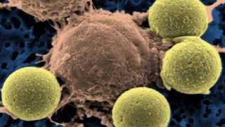 First Gene-Altering ‘Living Drug’ for Cancer Developed